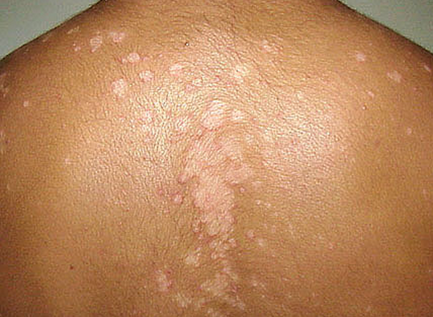 seborrhoeic-dermatitis